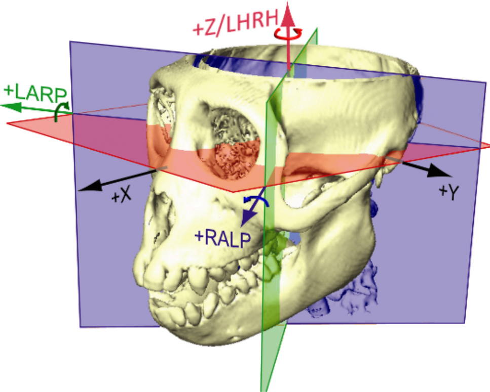 Effects of Electrode Position on Vestibular Implant Performance in Rhesus Macaque