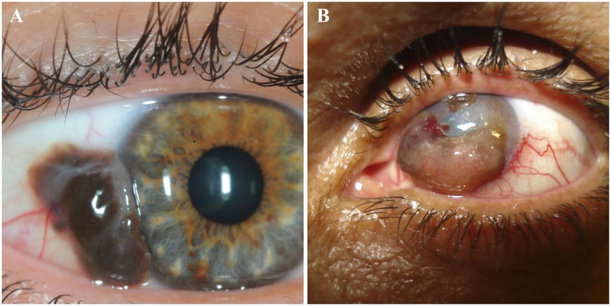 Ocular Melanoma: an Update on Surgical Approaches To Diagnosis, Characterization, and Therapy