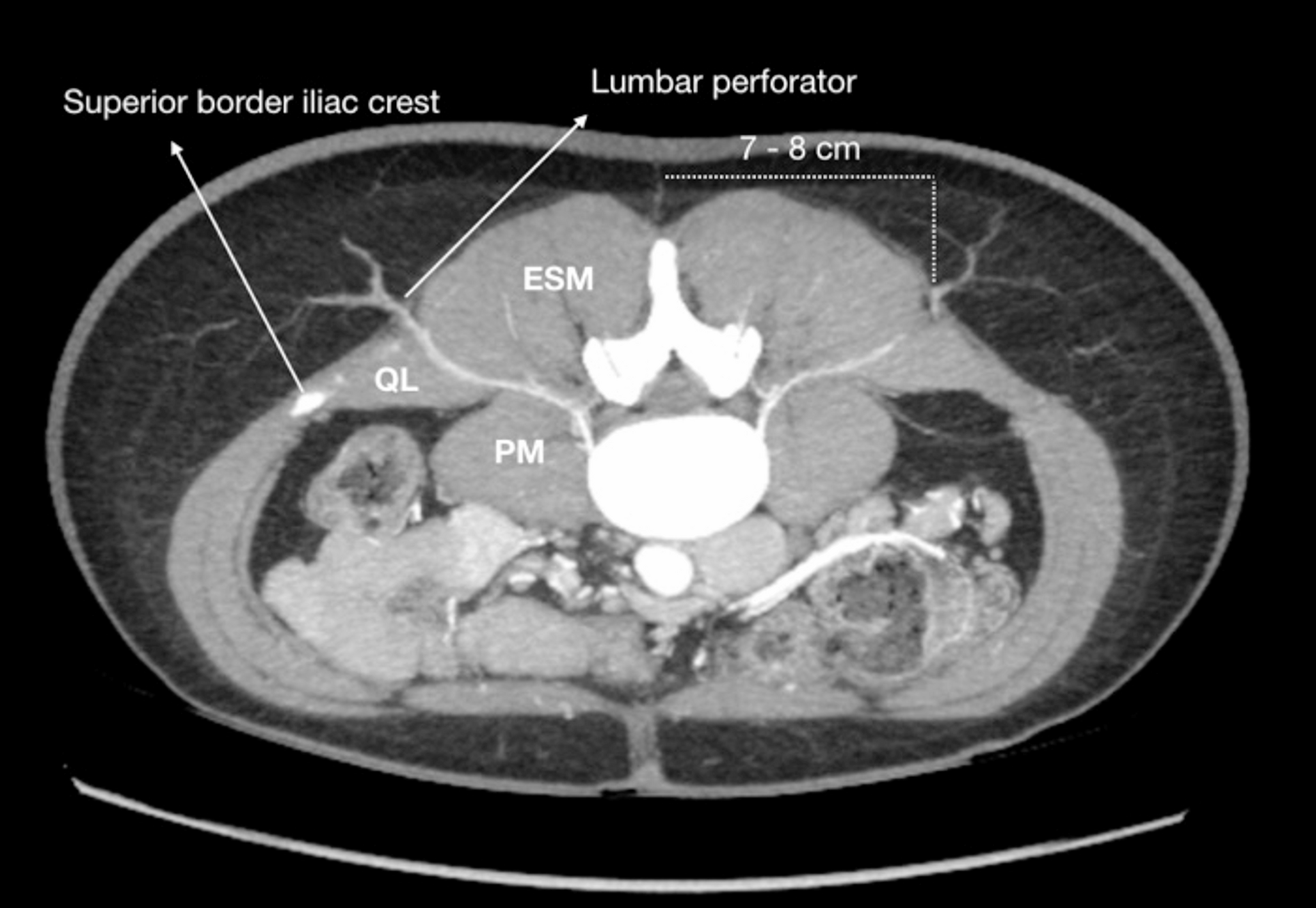 The Lumbar Artery Perforator Flap in Breast Surgery