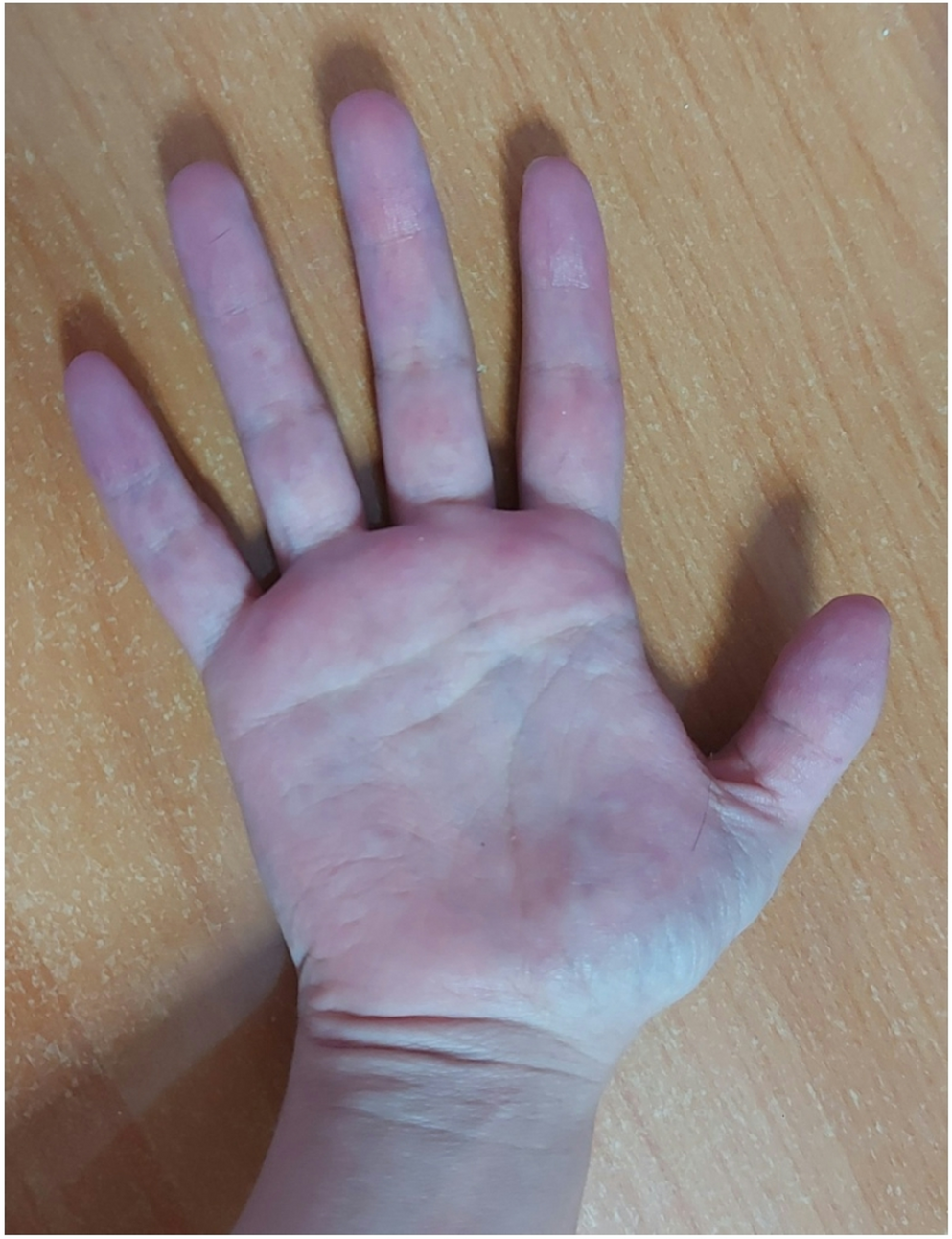 Rare co-existence of 15q26 deletion syndrome and lymphangioleiomyomatosis: diagnostic and therapeutic challenge