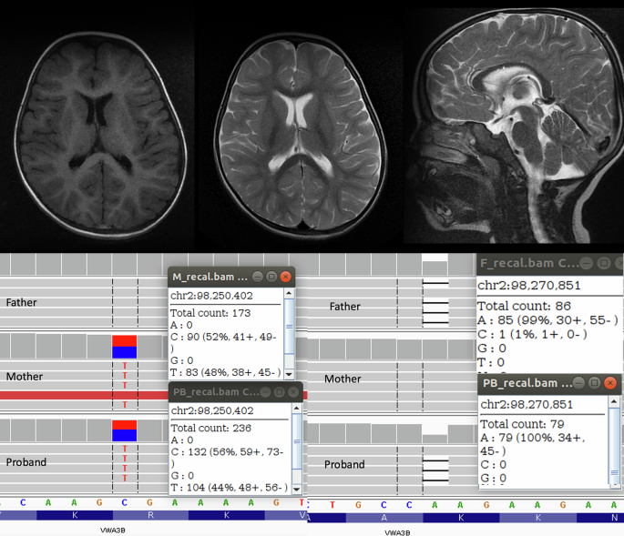 Childhood-onset ataxia with dystonia: expanding the spectrum of VWA3B-related disorders