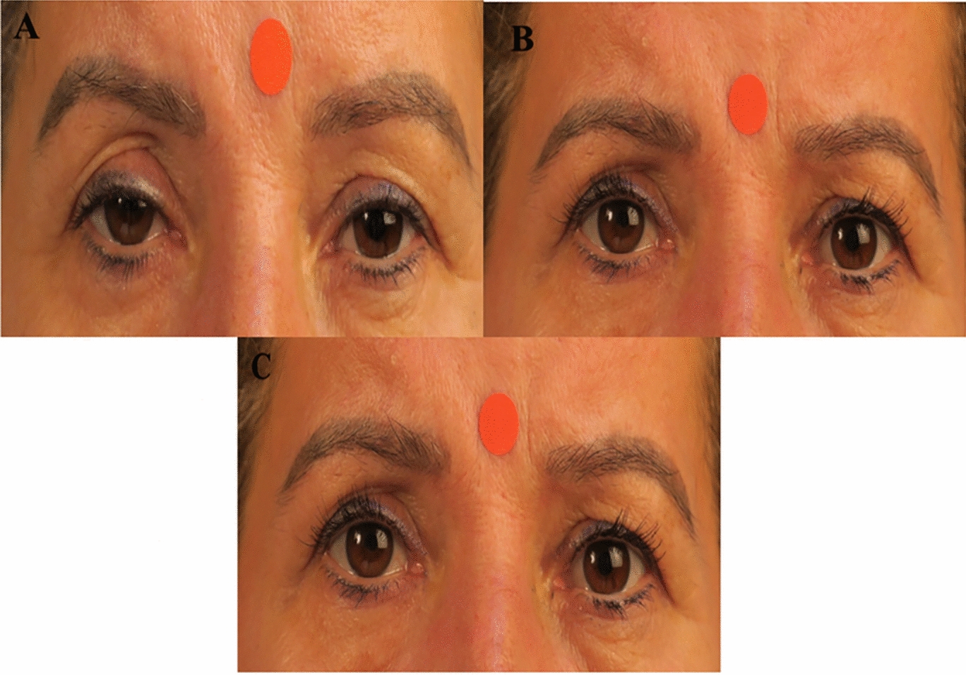 Predictive value of a phenylephrine-guided resection algorithm in optimizing eyelid symmetry following bilateral Müller Muscle–Conjunctival Resection