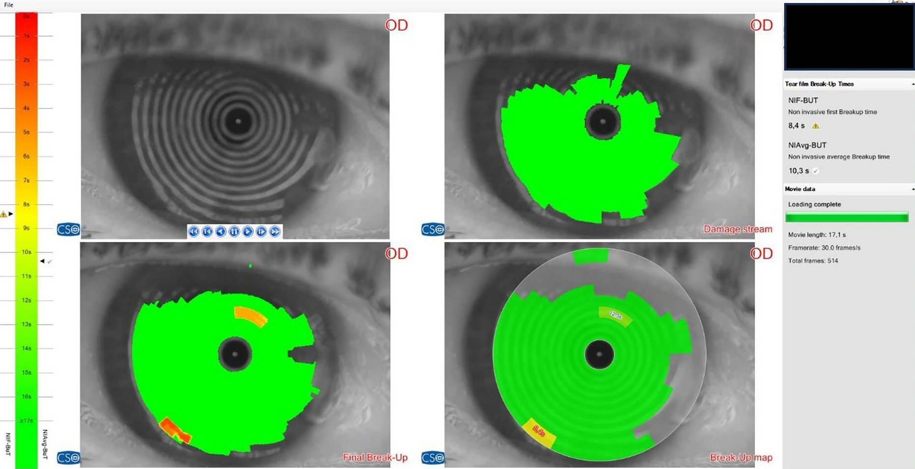 Evaluation of blepharoptosis, meibomian gland morphology, and dry eye parameters in older individuals with sarcopenia: a case–control study