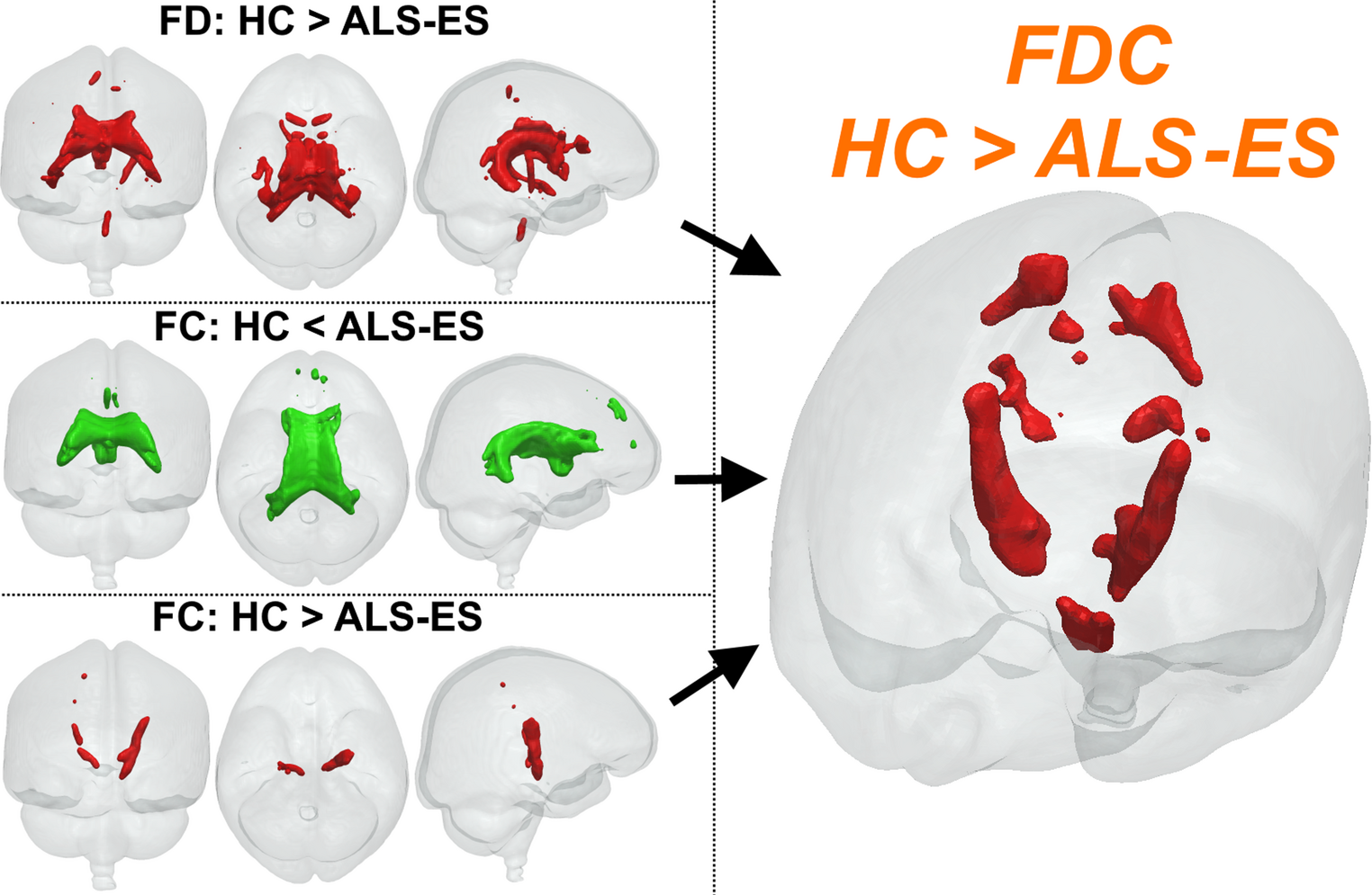 Fixel-based analysis to detect early fiber-specific white matter alterations in sporadic patients with amyotrophic lateral sclerosis
