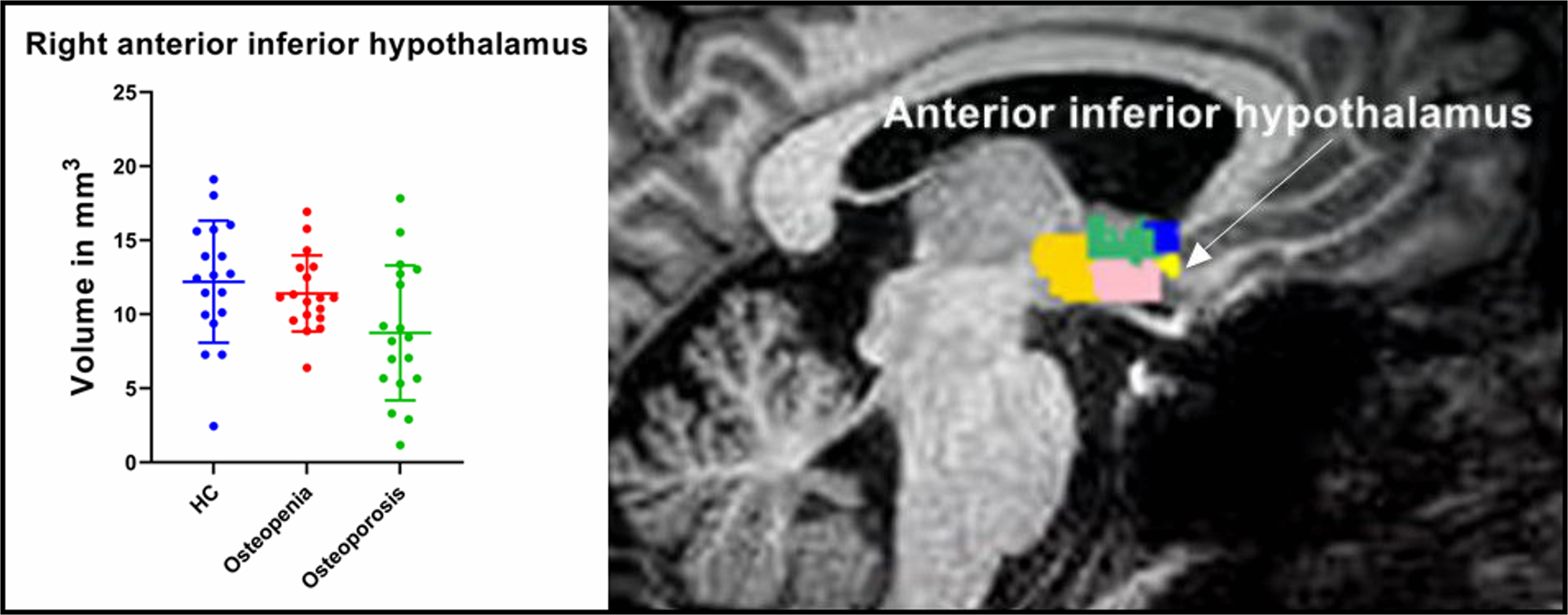 Multimodal MRI reveals hypothalamic structural-functional alterations associated with bone mineral density loss in postmenopausal women