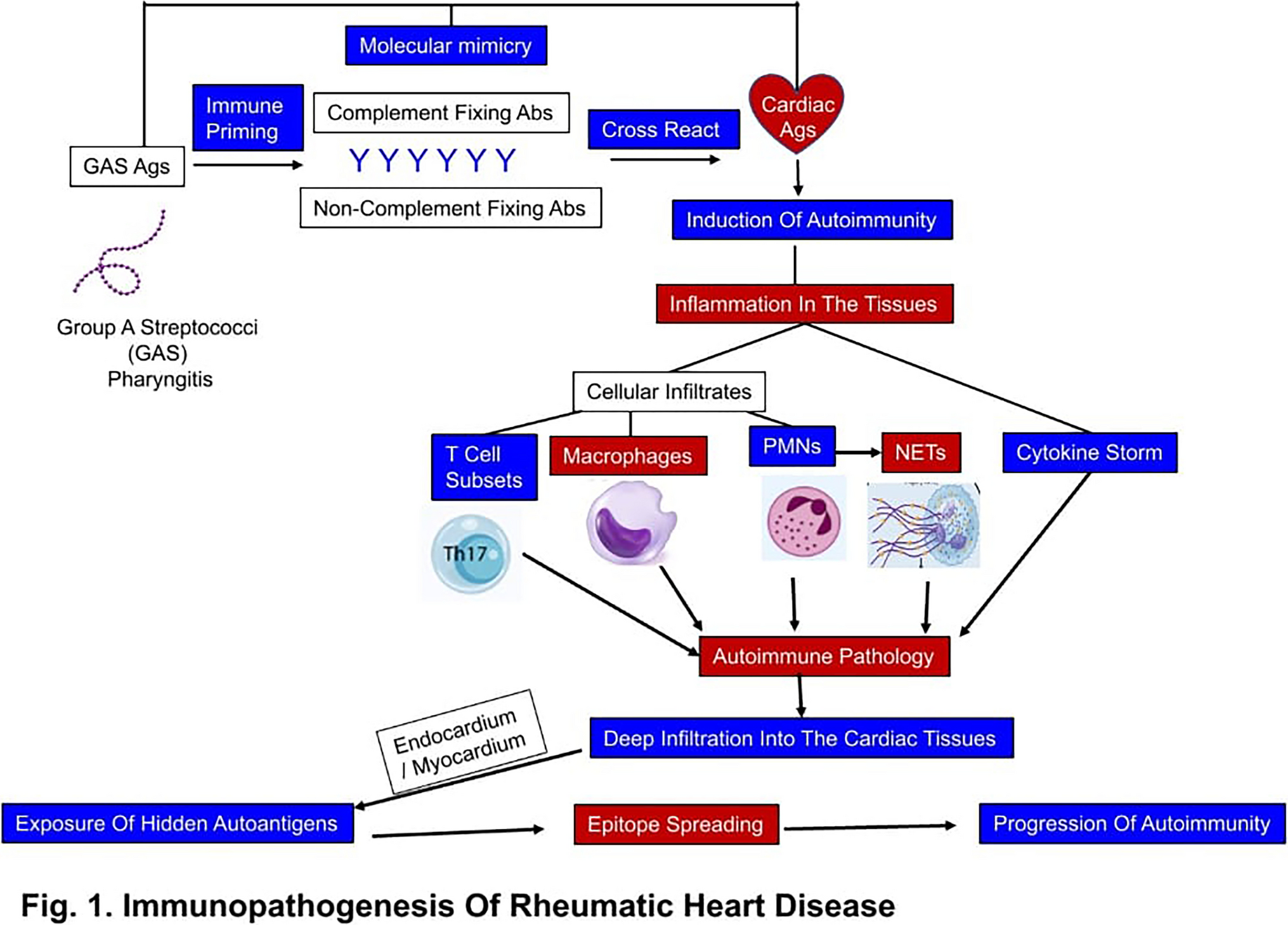 Neutrophil Extracellular Traps and Complement Pathways: The Missing Links in Acute Rheumatic Fever and Rheumatic Heart Disease Pathogenesis