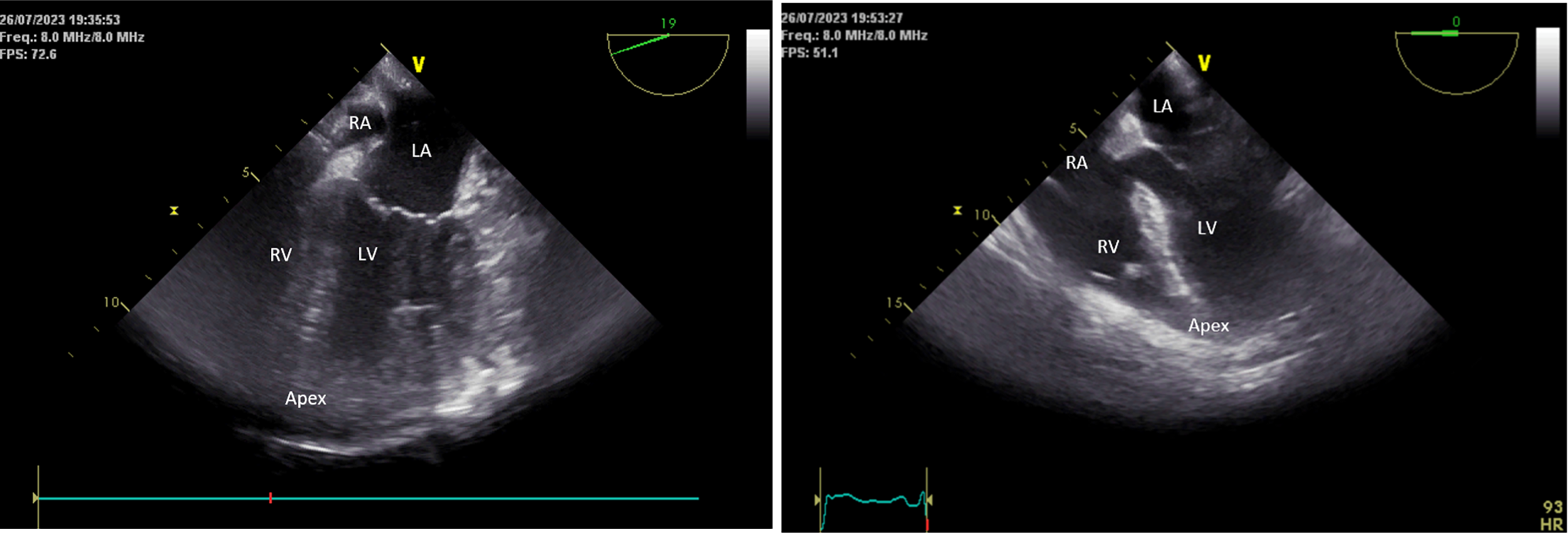 Transesophageal echocardiography to rapidly diagnose cardiac herniation following pneumonectomy