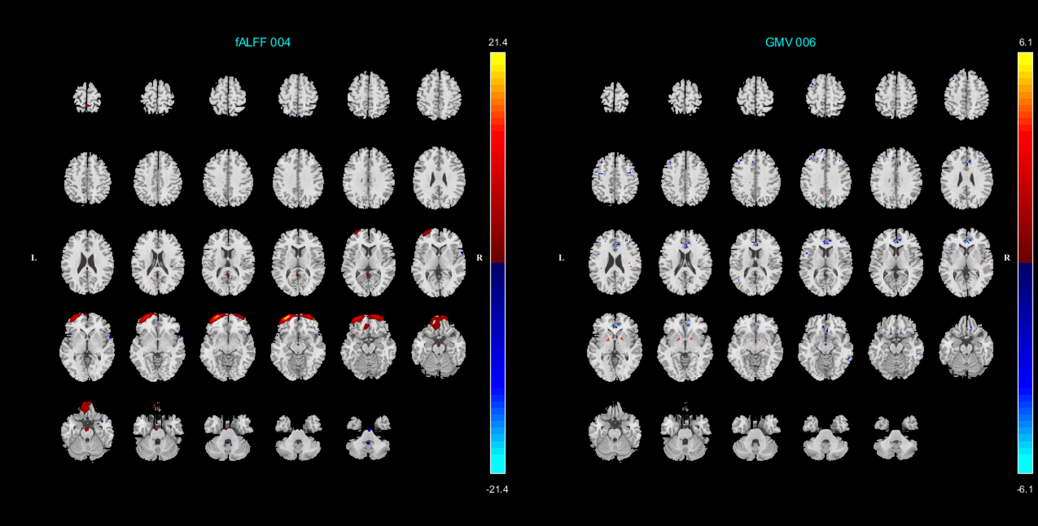 Aberrant fronto-limbic network in adolescents with attention-deficit/hyperactivity disorder: a multimodal MRI study using parallel ICA