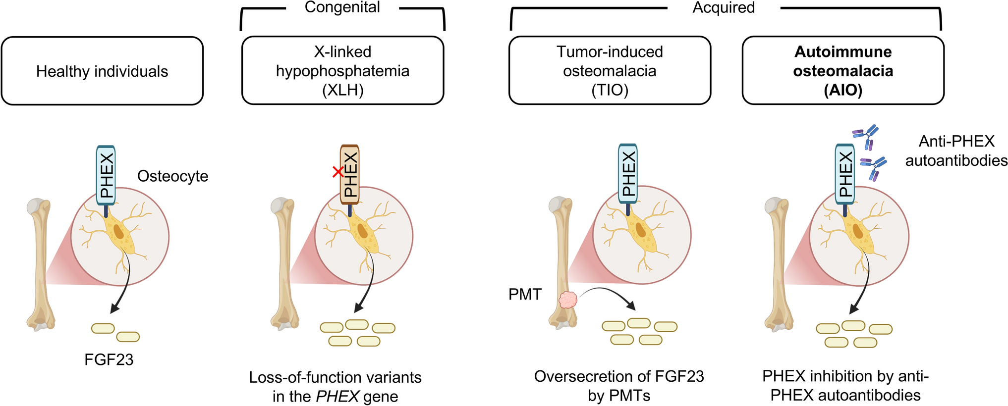 Autoimmune osteomalacia: a novel FGF23-related hypophosphatemic osteomalacia