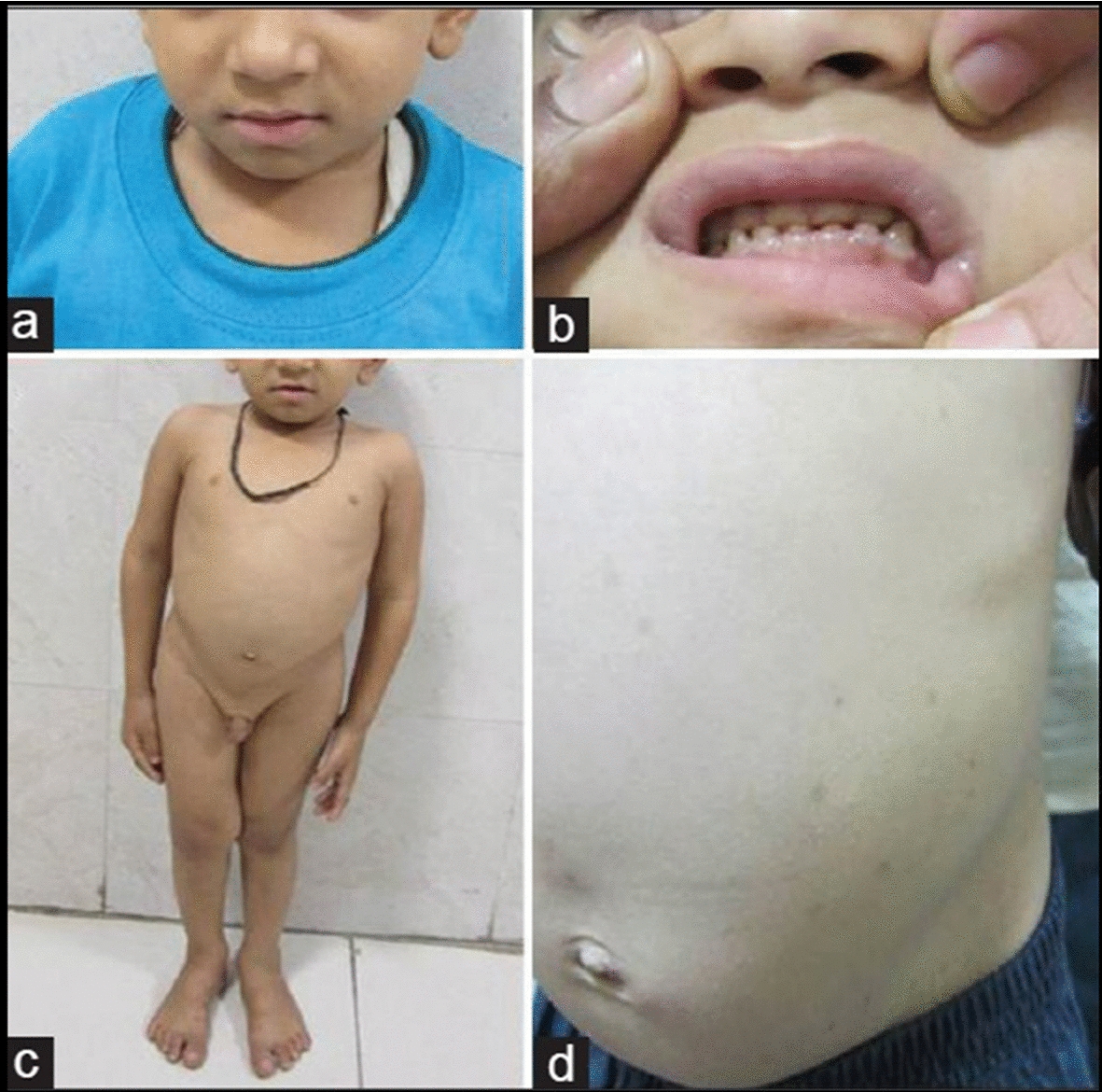 Copy number variation: an important genetic mechanism in-related immunoosseous dysplasia (Schimke type) in Indian patients