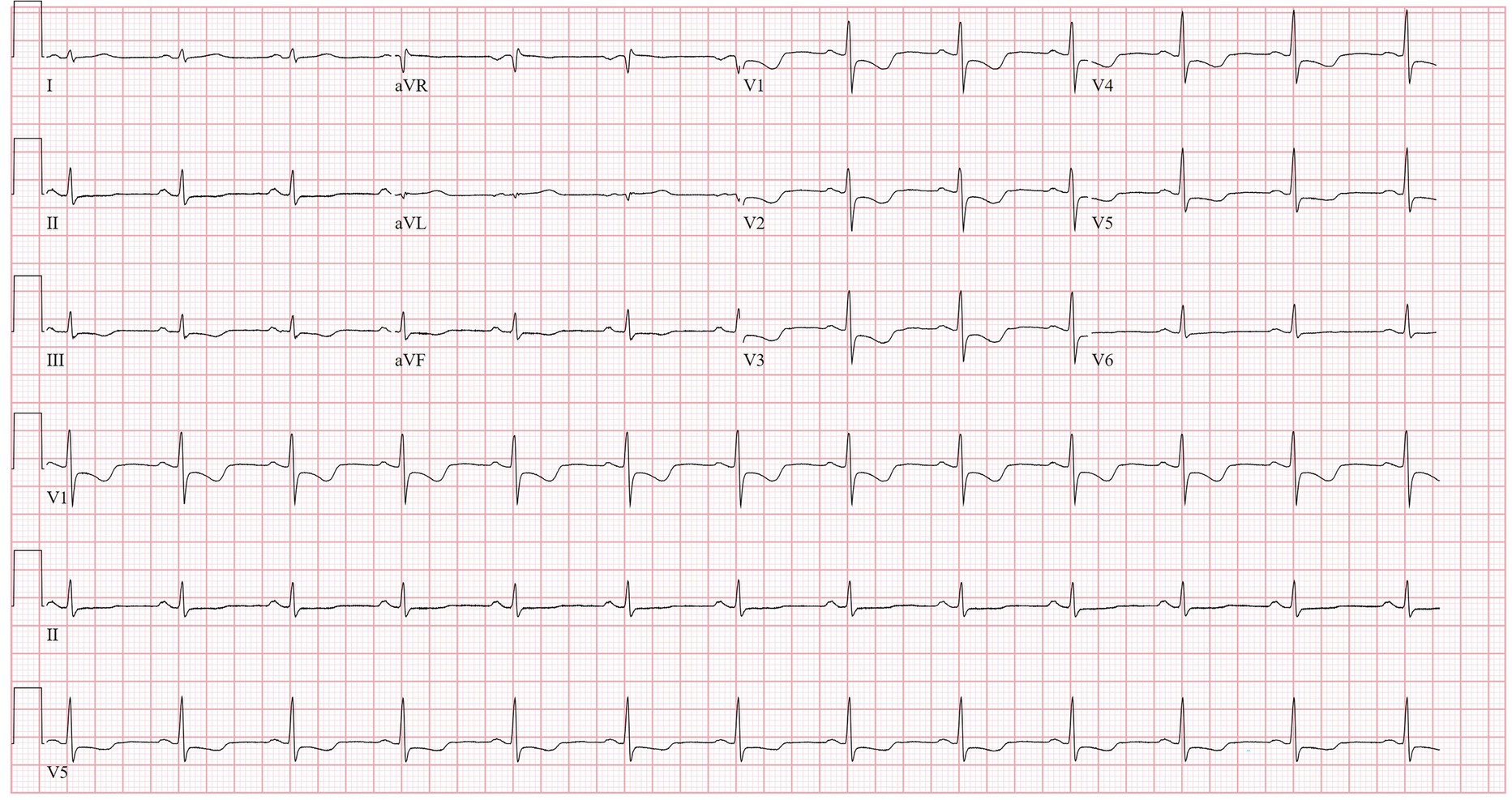 Reverse Takotsubo Cardiomyopathy After an Adverse Reaction to Alteplase Treated with Intravenous Epinephrine
