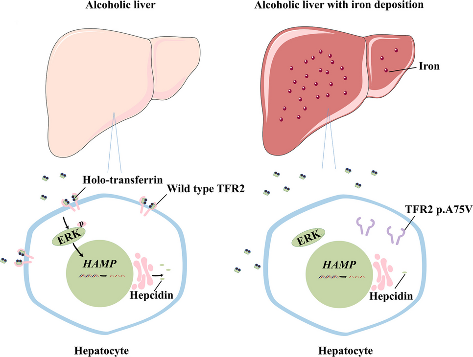 TFR2 p.A75V mutation aggravates liver iron overload in alcoholic liver disease via ERK pathway