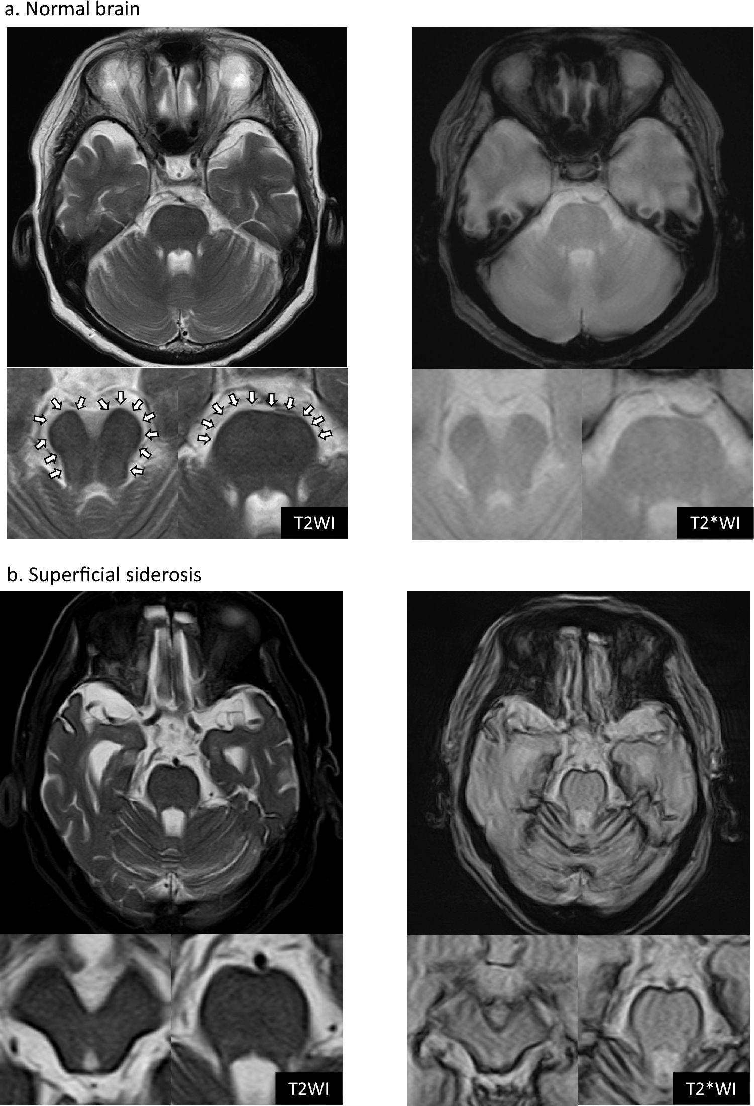 Low-intensity rim on T2-weighted brainstem imaging: a universally observed structure exhibiting a negative magnetic susceptibility effect