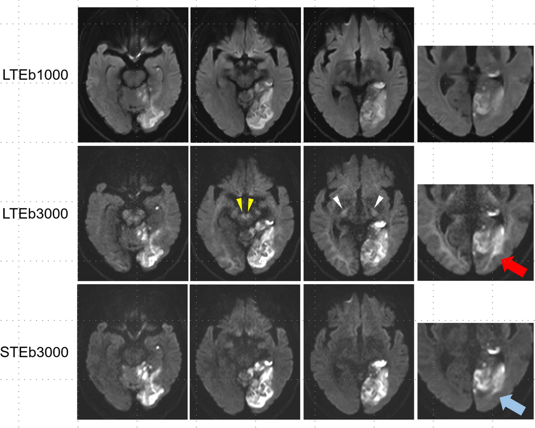 High--value spherical tensor encoding diffusion-weighted imaging of acute stroke