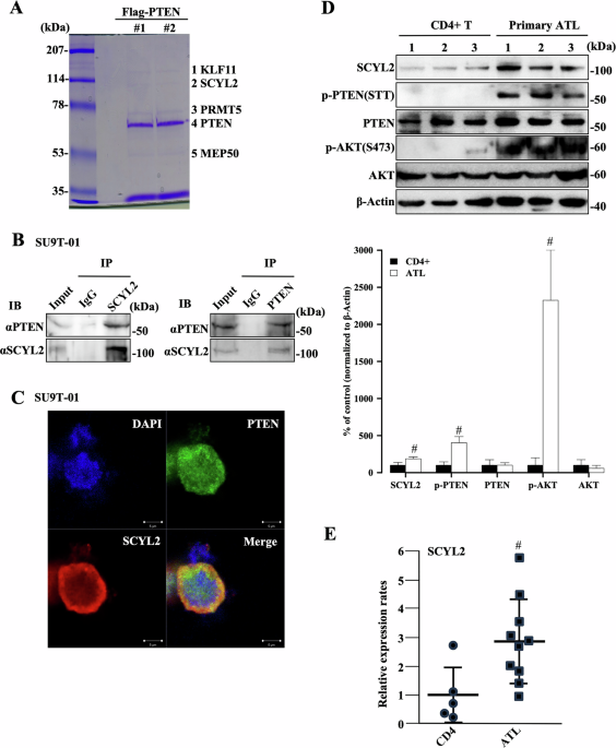 Clathrin-associated SCYL2 contributes to the activation of PI3K/AKT signaling and tumorigenesis through PTEN phosphorylation in adult T-cell leukemia/lymphoma