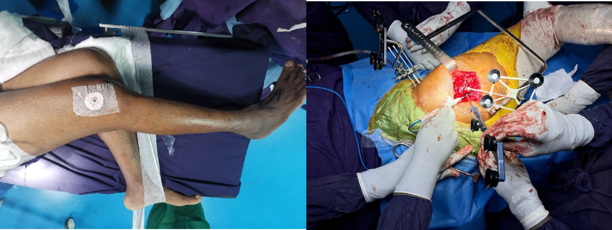 Enhanced and express workflows in robotic total hip arthroplasty: A paired accuracy study using radiographic validation