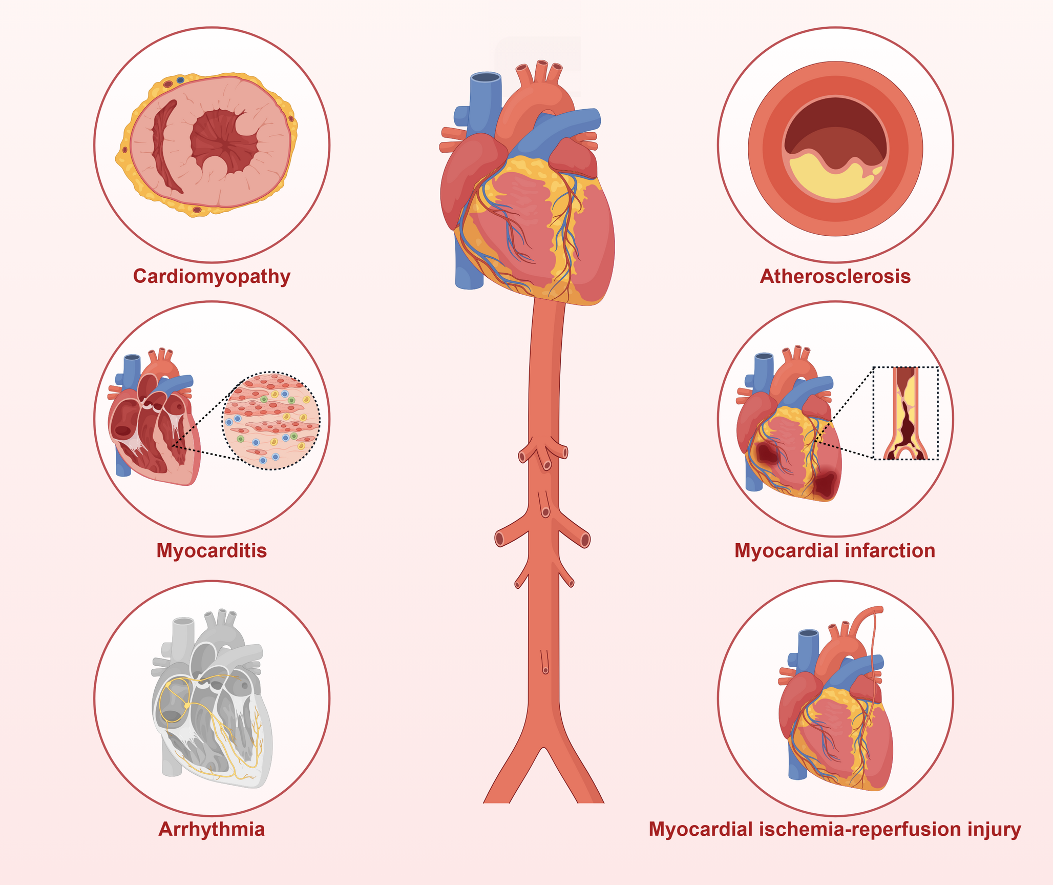 Therapeutic Ultrasound in Cardiovascular Medicine: Applications of Low-intensity Pulsed Ultrasound and Ultrasound-targeted Microbubble Destruction