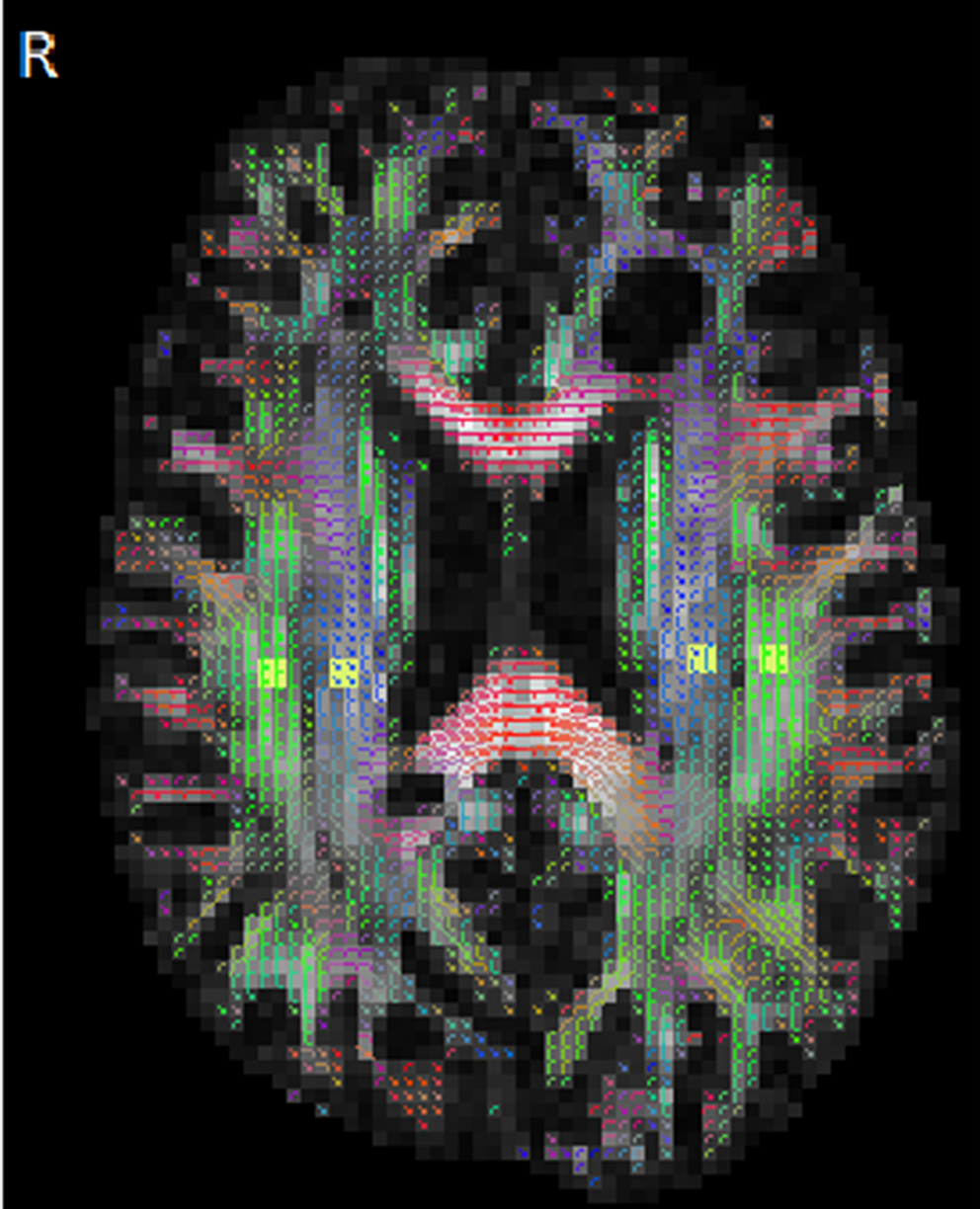 Longitudinal changes of neurocognitive function and ALPS-index in patients with brain tumors receiving brain irradiation