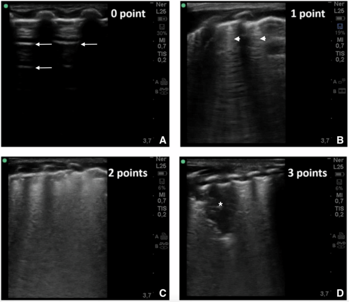 Trajectory of lung ultrasound scores in preterm infants at risk for bronchopulmonary dysplasia