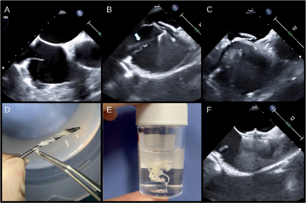 Incidental extraction of the chiari network following entrapment of a PFO occluder delivery system