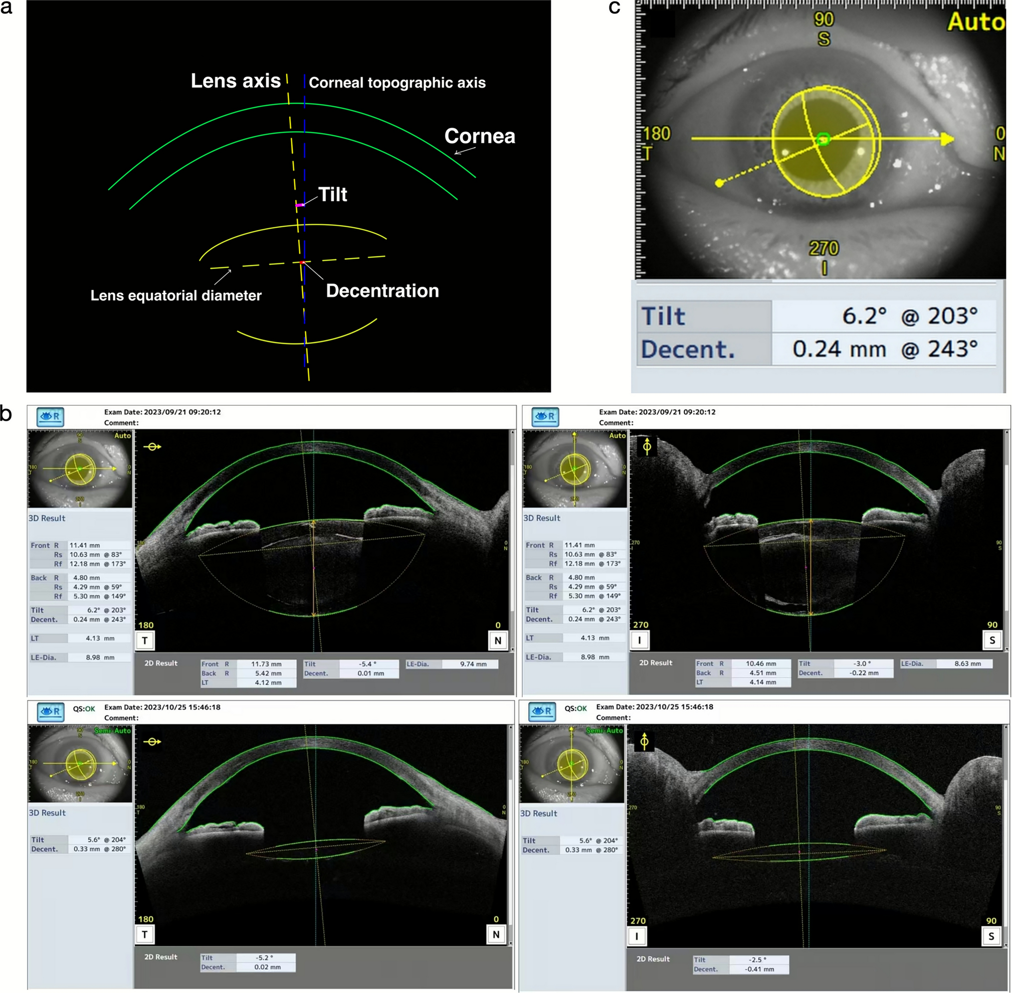 The intraocular lens position in high myopia eyes