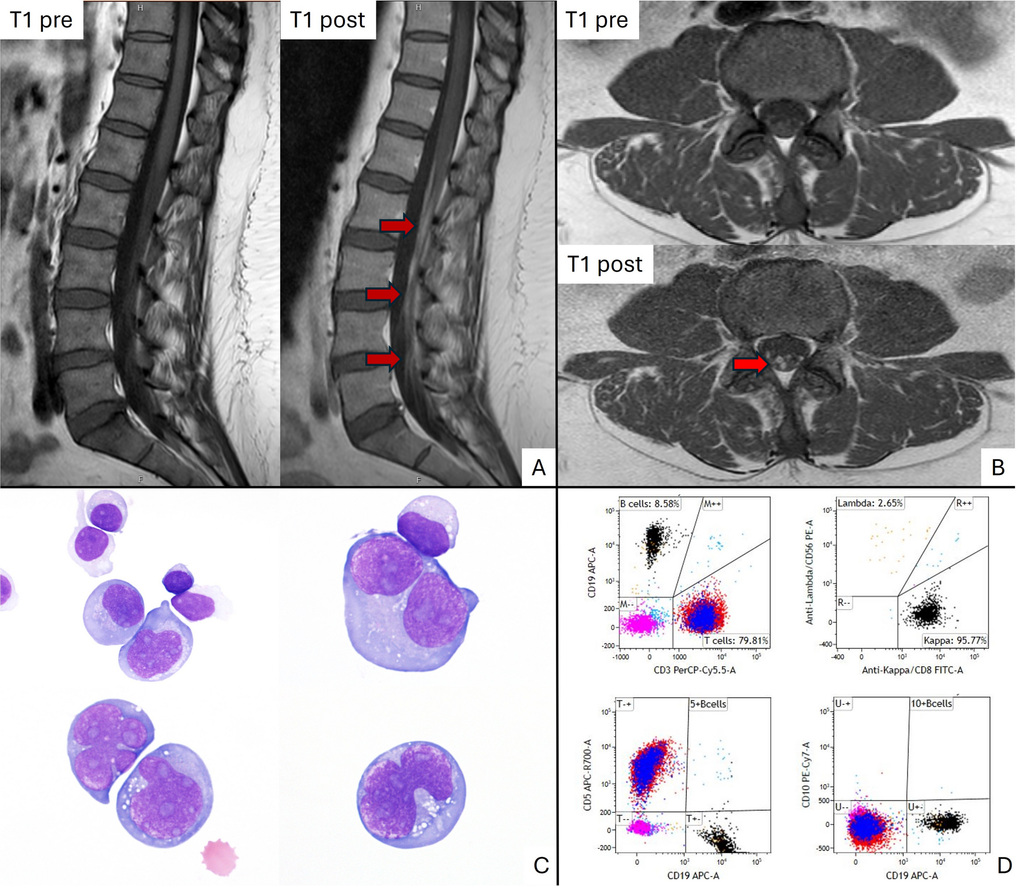 Primary diffuse large B-cell lymphoma of cauda equina: a rare and challenging diagnosis