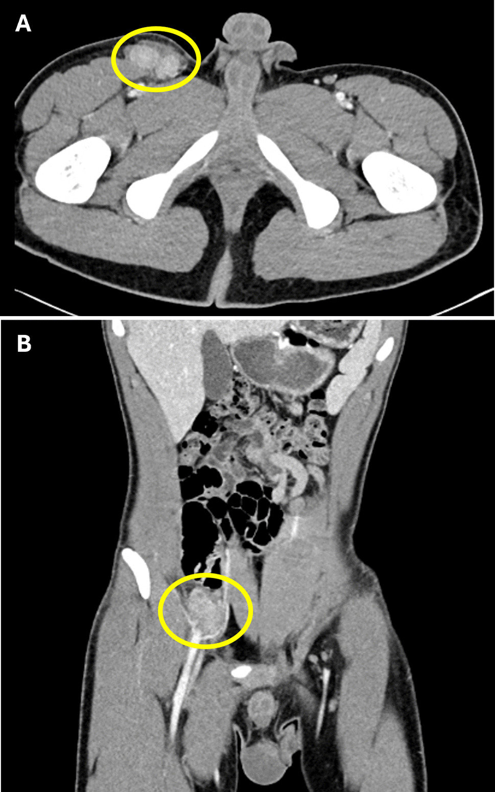 Histopathologic findings of tularemia lymphadenitis