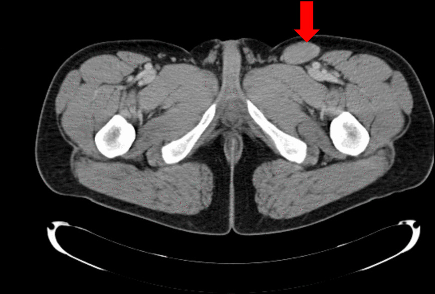 A rare diffuse follicular lymphoma with  mutation and copy-neutral loss of heterozygosity at 1p36: insights into diagnosis, disease progression, and literature review