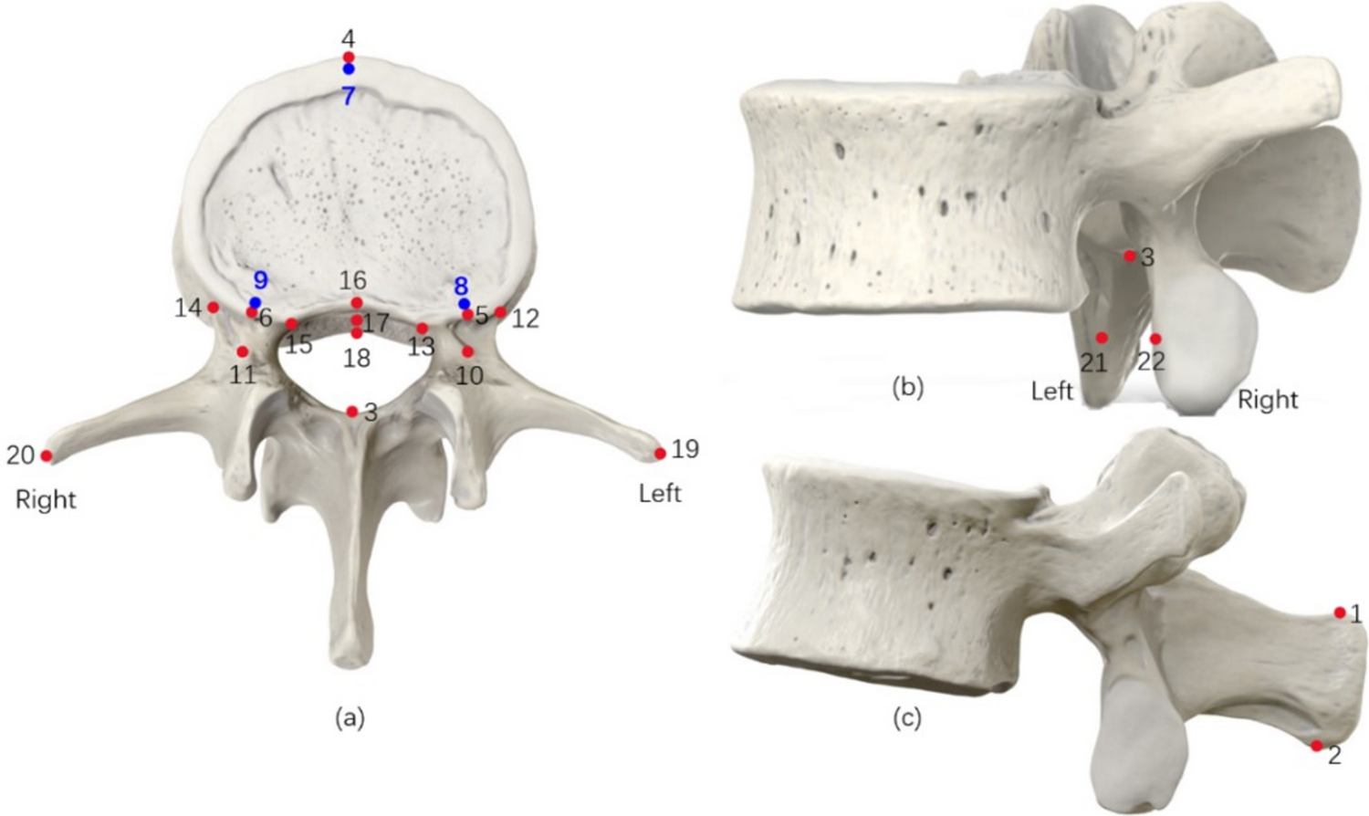 The Development and External Testing of Deep Learning Model for Automated Classification of Intervertebral Disc Degeneration on CT Images