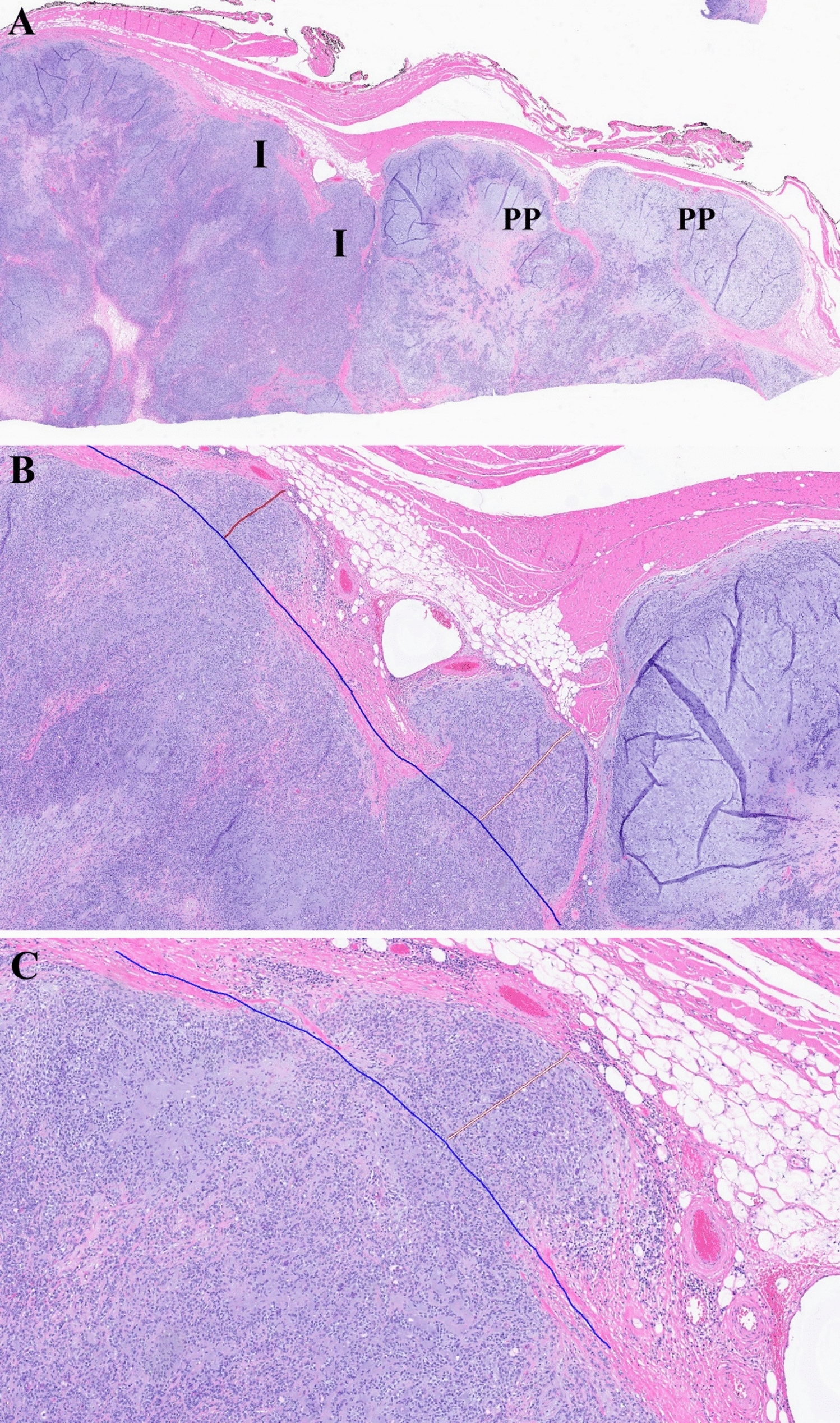 International Consensus Guidelines for Diagnostic Criteria and Checklist for Future Studies for Minimally Invasive Carcinoma ex Pleomorphic Adenoma: An HN CLEAR Initiative