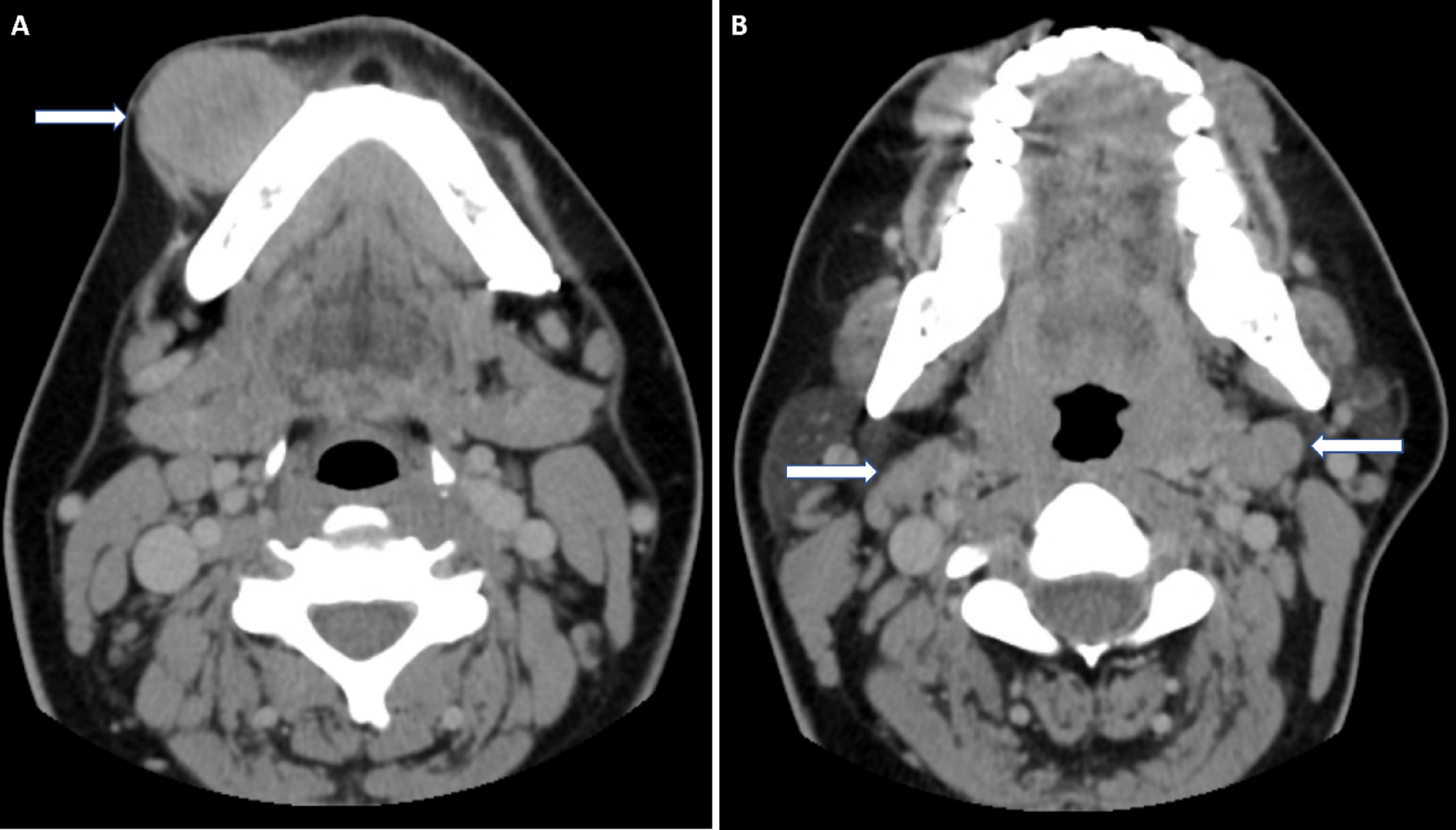 Molecularly Variant Synovial Sarcoma of the Lower Lip: :: Fusion as a Diagnostic Pitfall in the Head and Neck