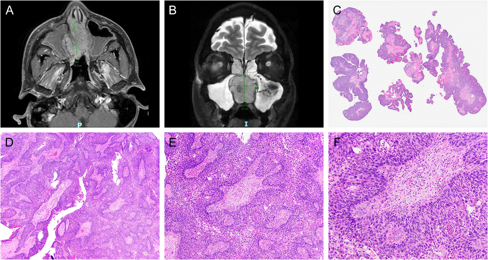 Sinonasal Nonkeratinizing Squamous Cell Carcinoma with Synchronous Presence of HPV-High Risk and  Fusion