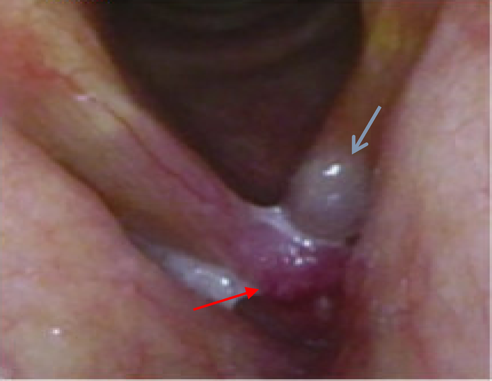 Laryngeal ALK Positive Histiocytosis: Potential Mimic of Inflammatory Myofibroblastic Tumor—Case Report and Literature Review