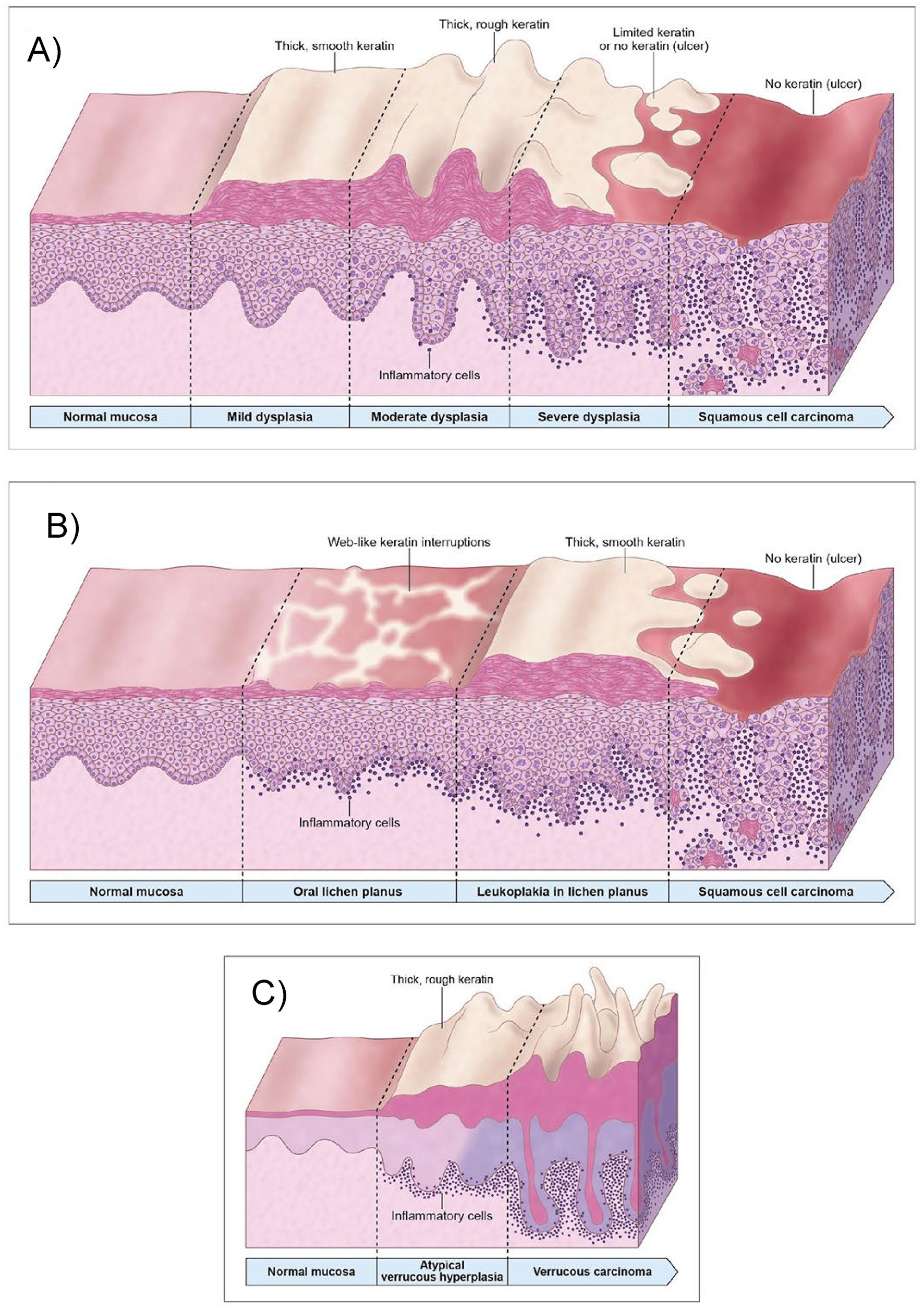Spatial transcriptomics and artificial intelligence: a scoping review of emerging applications in head and neck pathology