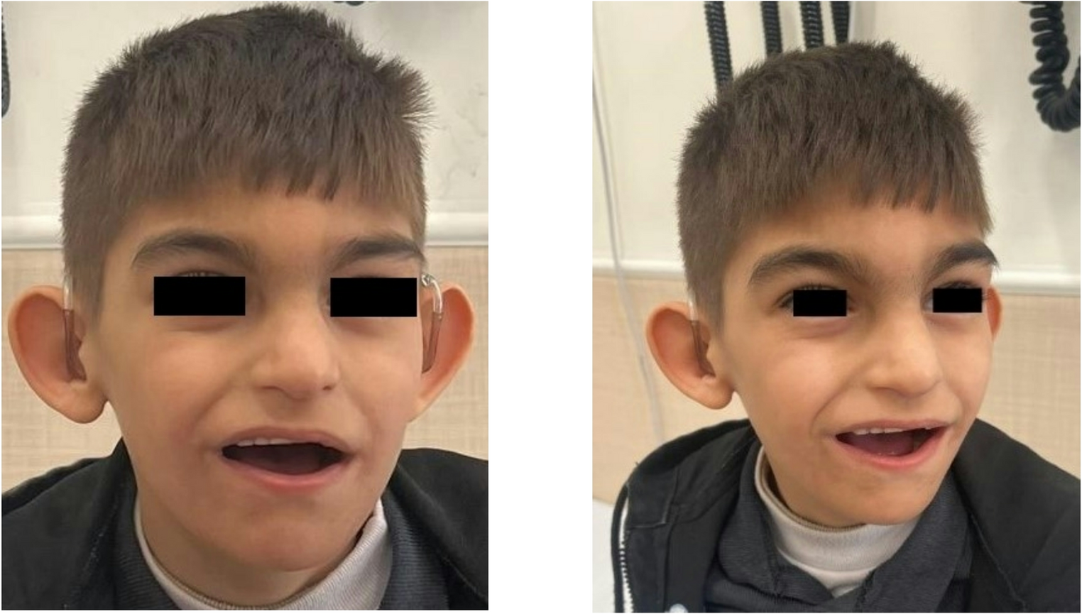 TASP1-Related Suleiman–El-Hattab Syndrome: The First Genetically Confirmed Case in Iran Accompanied by a Comprehensive Literature Review