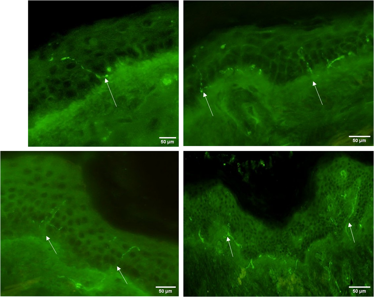 Cutaneous α-Synuclein Pathology as a Differential Marker: A Histological and Statistical Comparison across Neurodegenerative Disease Groups