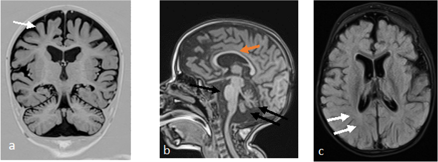 Expanding the Clinical Spectrum of SCN8A-Related Epileptic Encephalopathy: Additional Auditory Impairment, Atypical MRI Abnormalities and Putative Mitochondrial Involvement