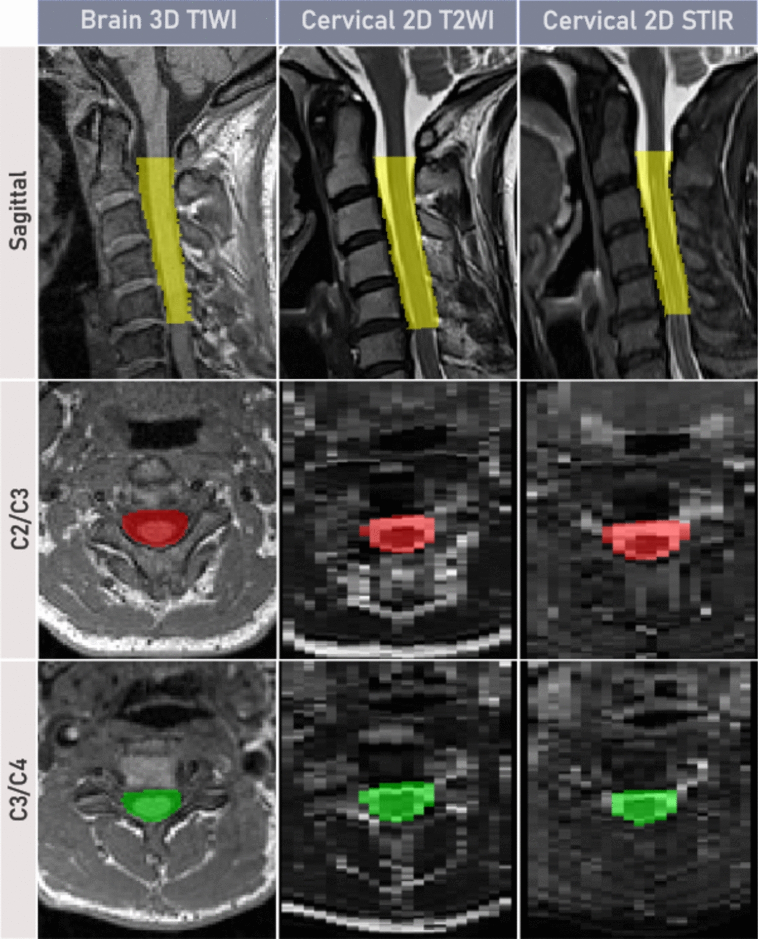 Assessing the cervical canal area in multiple sclerosis with spinal cord sagittal 2D T2-weighted sequences