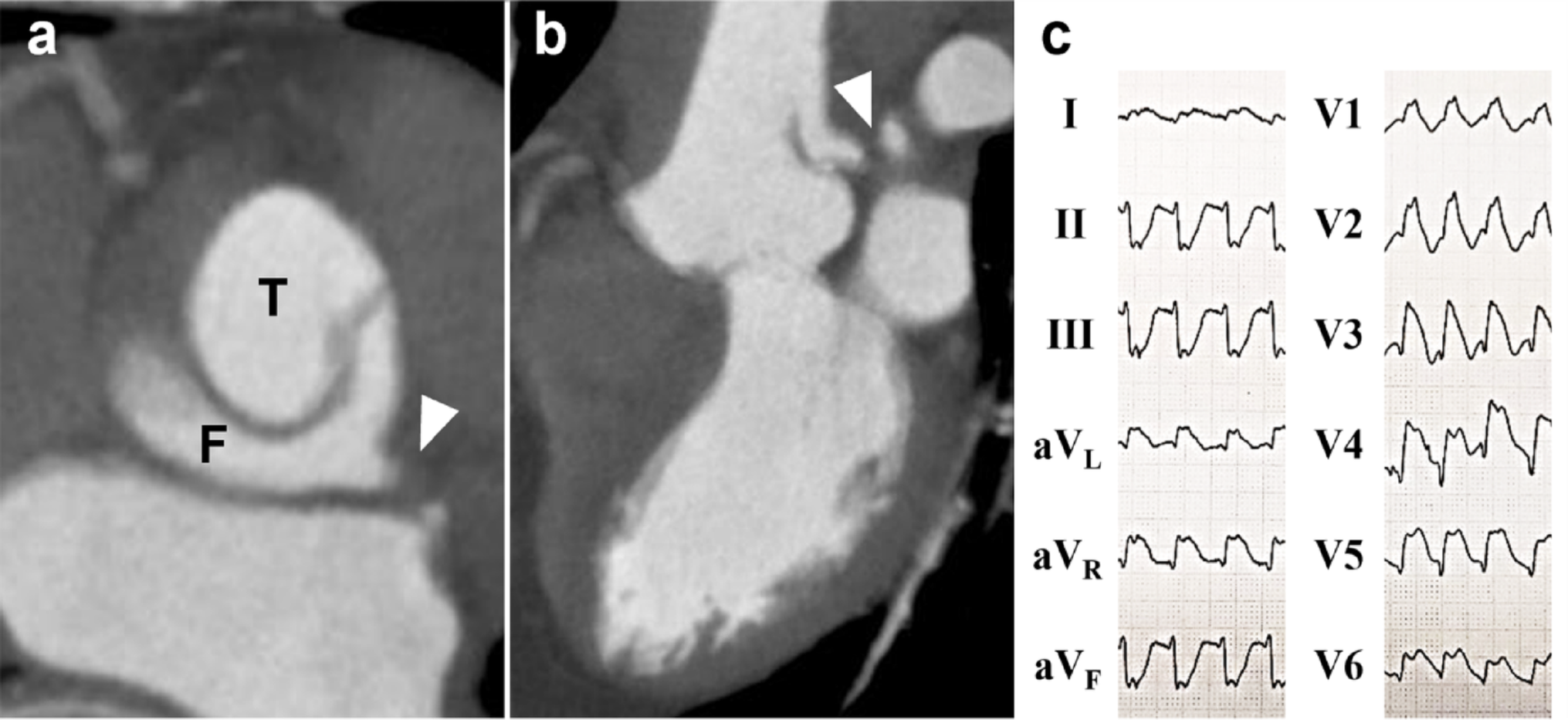 Heart transplantation following a successful bridge-to-bridge strategy in acute type A aortic dissection with left main coronary malperfusion