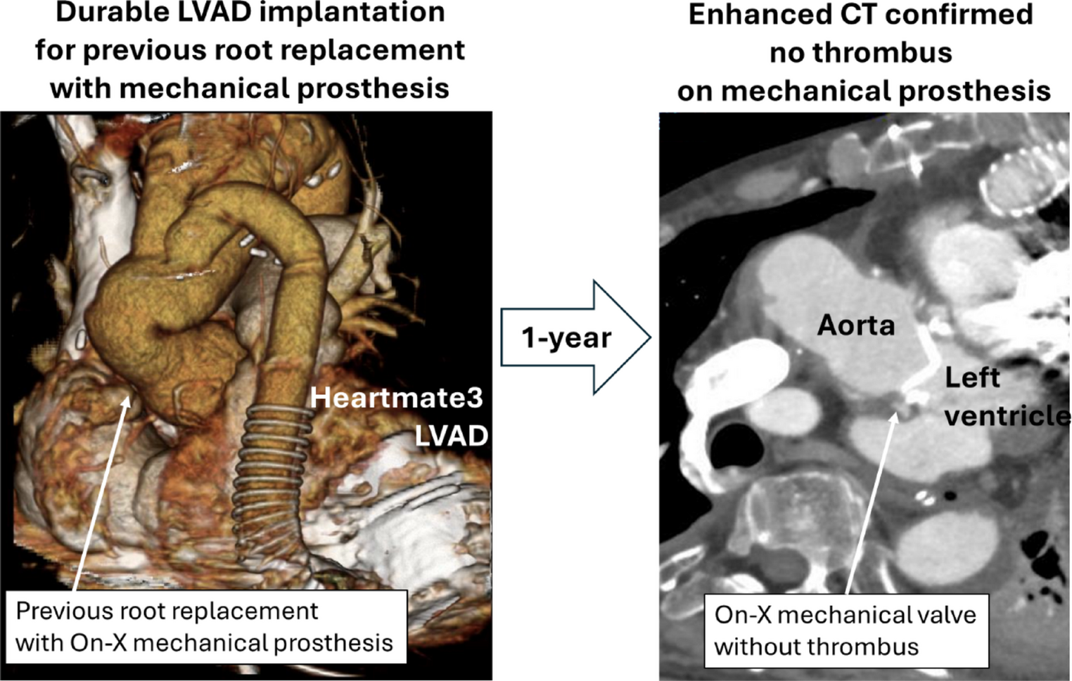 Successful bridge with extracorporeal left ventricular assist device in a patient with aortic mechanical valve prosthesis