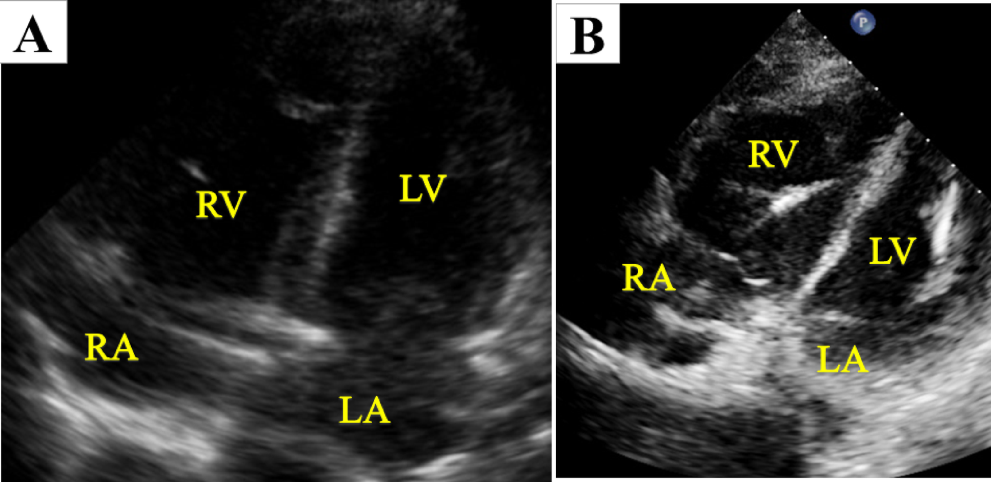 Extracorporeal biventricular support through left mini-thoracotomy