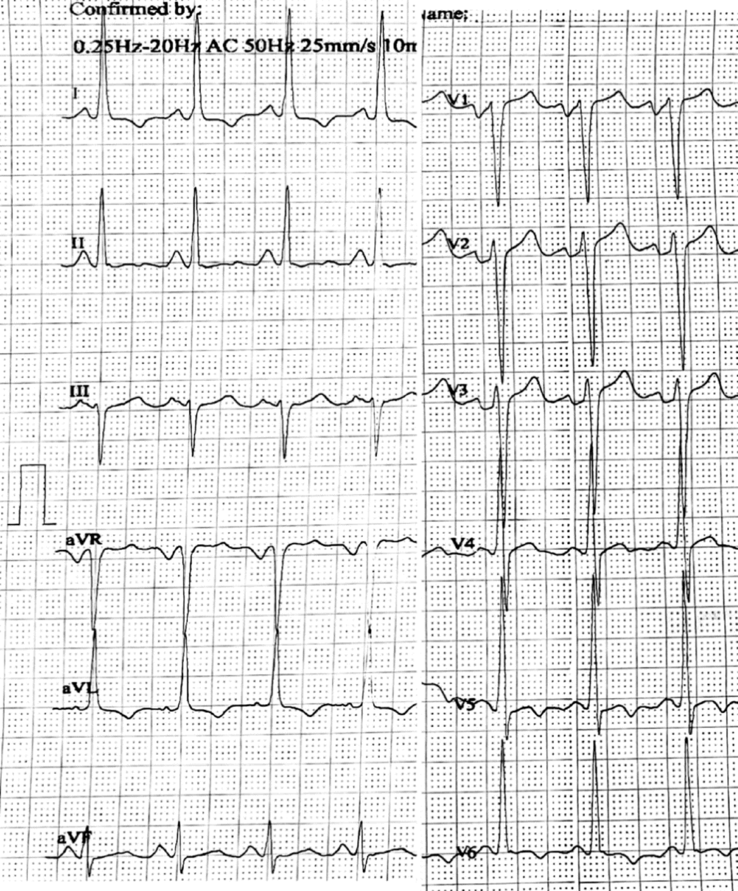 Early recognition of atypical hemolytic uremic syndrome to prevent irreversible kidney injury: cardiac failure and refractory hypertension as critical clues in young patients