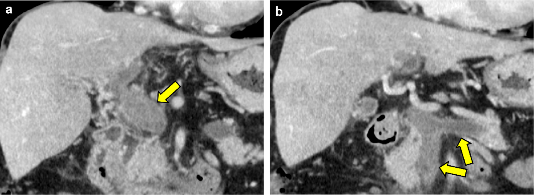 Non-cirrhotic portal–splenic–mesenteric vein thrombosis unmasking  V617F-positive polycythemia vera