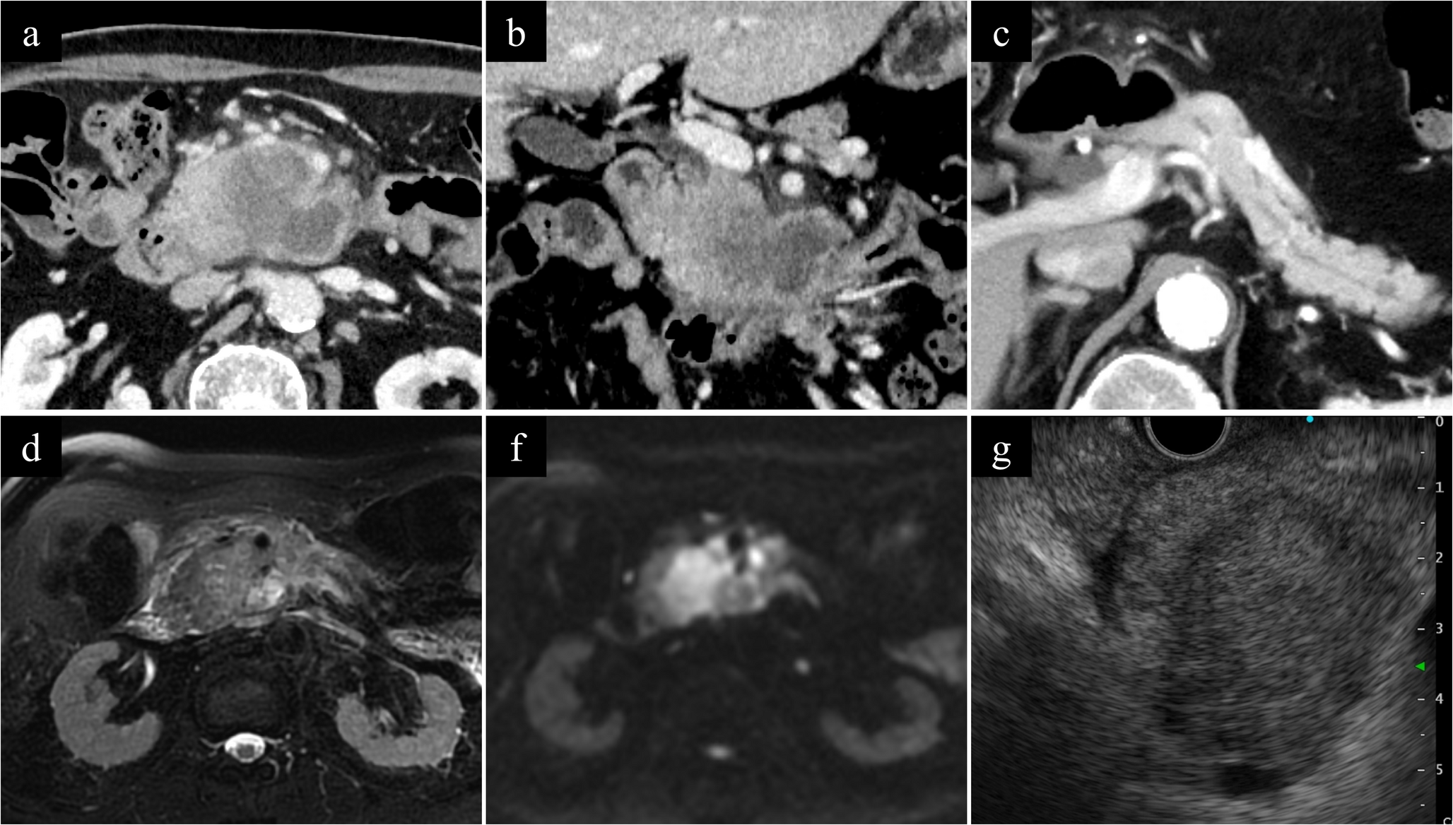 Intratumoral perforation following endoscopic duodenal stent placement for pancreatic cancer with gastric outlet obstruction