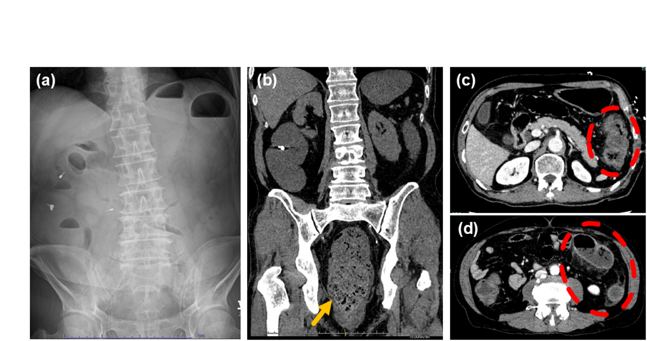 An extremely rare case of stercoral colitis with a subsequent benign stricture: preoperative thin endoscopic assessment to optimize surgical extent