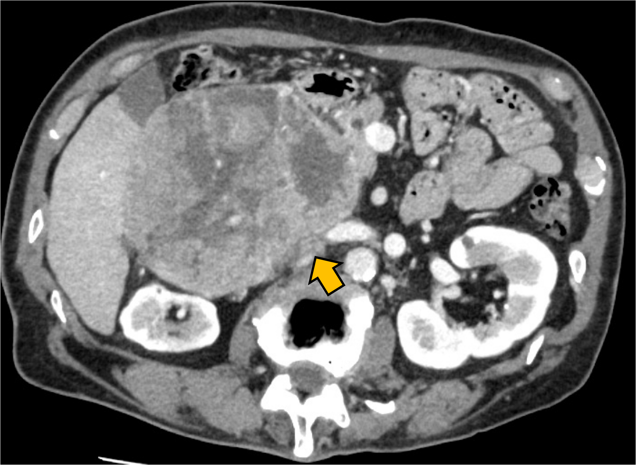 Delayed diagnosis of acquired hemophilia a complicating hepatocellular carcinoma: a rare case of hepatectomy following atezolizumab and bevacizumab therapy