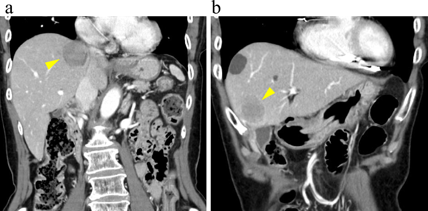 Successful management and 10-year survival of a rectal neuroendocrine tumor with rare systemic metastases via a non-portal venous pathway