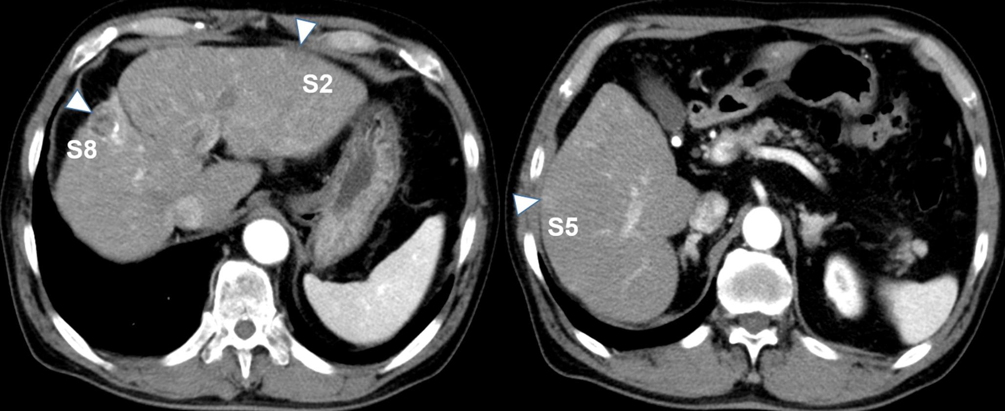 Thoracoscopic biopsy should be considered for pulmonary nodules with the halo sign during immunotherapy for hepatocellular carcinoma