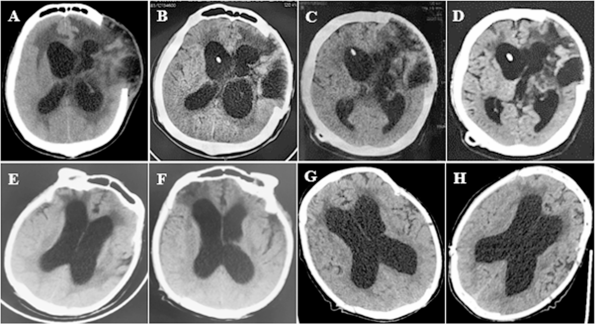 Outcomes following shunt for secondary hydrocephalus in patients with prolonged disorders of consciousness: a matched cohort study