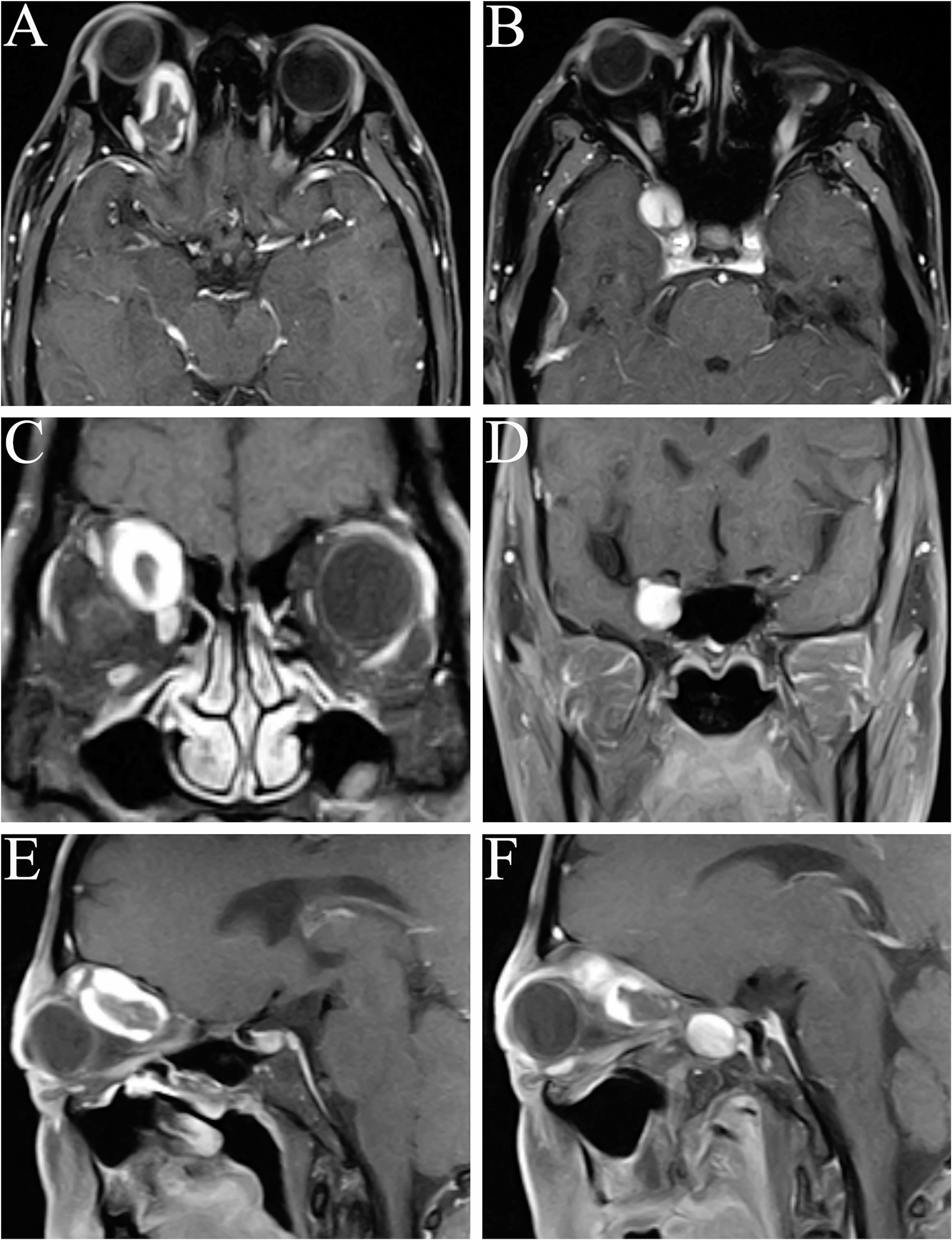 Outcomes of orbital-cavernous sinus schwannomas via pterional approach combined with orbital osteotomy: a retrospective study of 32 cases